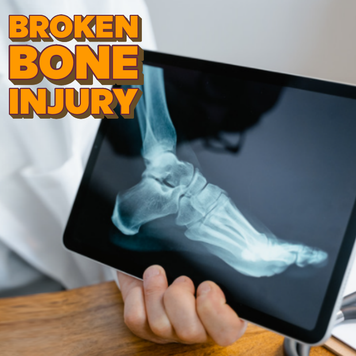 broken bone lawsuit